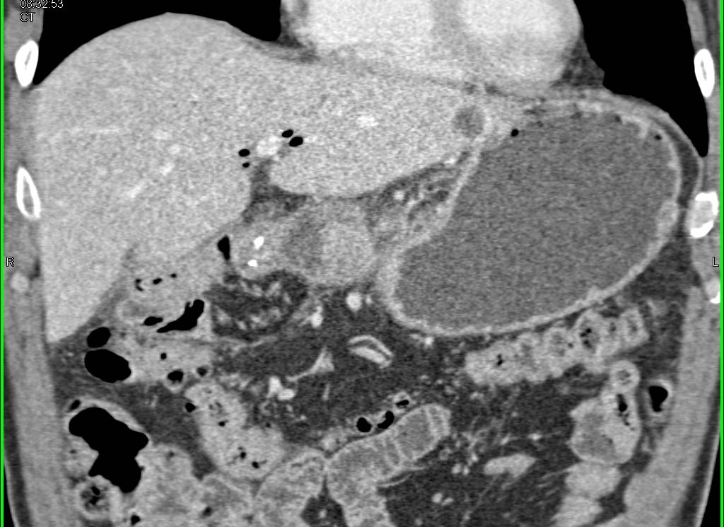 Normal Post Whipple Study - CTisus CT Scan