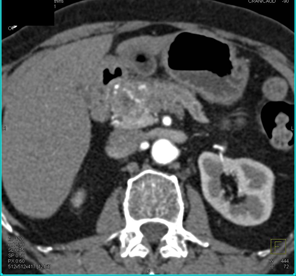 Pancreatic Neuroendocrine Tumor (PNE) - CTisus CT Scan