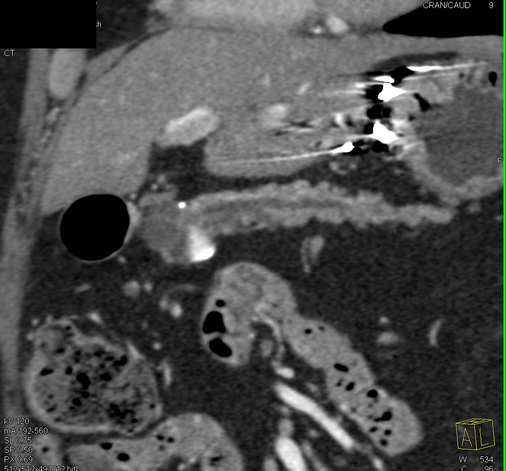 Pancreatic Duct Cutoff by a Carcinoma - CTisus CT Scan