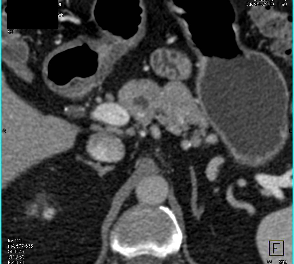 Intraductal Papillary Mucinous Neoplasm (IPMN) Tail of Pancreas with 3D Perspectives - CTisus CT Scan