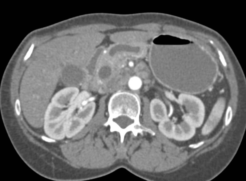 Ampullary Cancer with Double Duct Sign - CTisus CT Scan