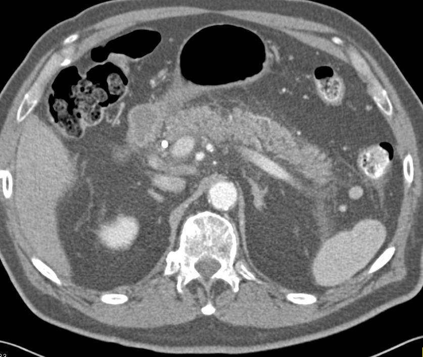 Acute Pancreatitis and Right Adrenal Myelolipoma - CTisus CT Scan