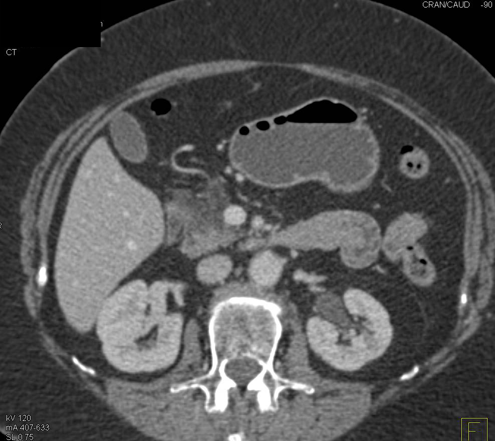 Acute Pancreatitis (mild) - Pancreas Case Studies - CTisus CT Scanning