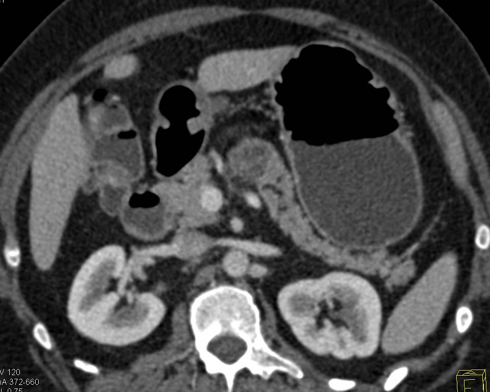 Intraductal Papillary Mucinous Neoplasm (IPMN) - CTisus CT Scan