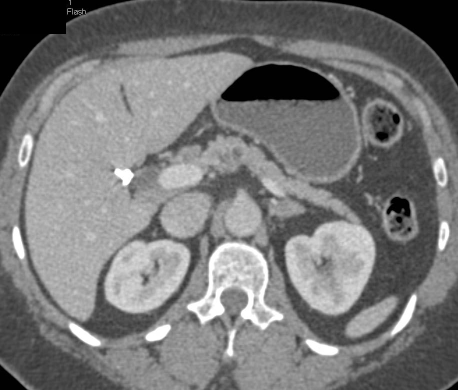 <1cm Intraductal Papillary Mucinous Neoplasm (IPMN) - CTisus CT Scan