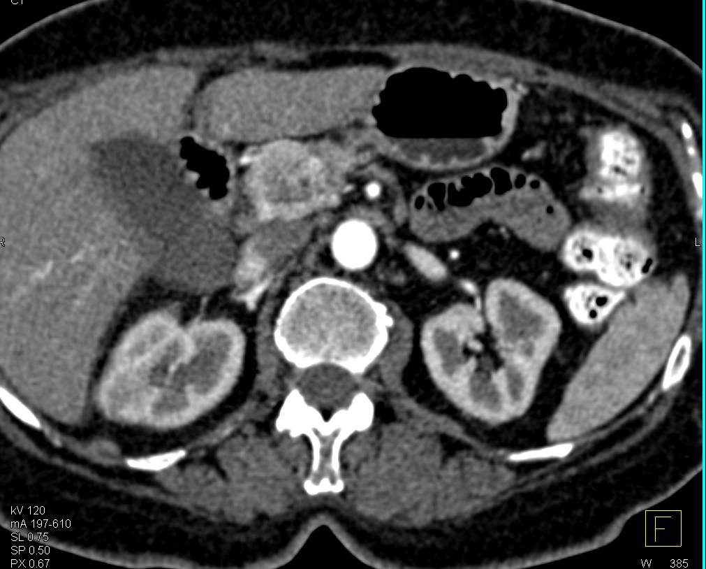 Neuroendocrine Tumor (PET) in Head of Pancreas - CTisus CT Scan