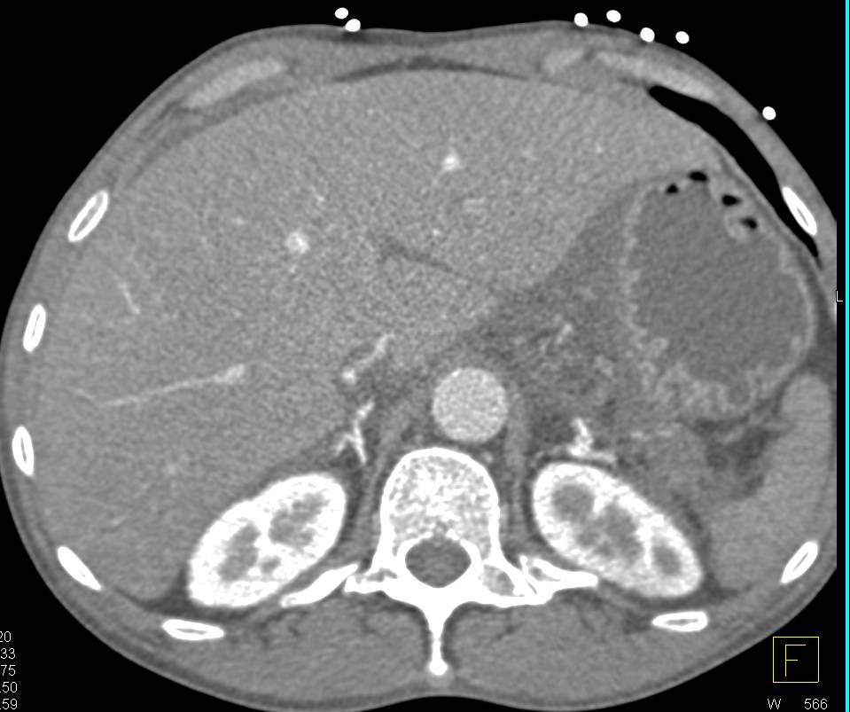 Acute Pancreatitis with Extensive Inflammation - CTisus CT Scan