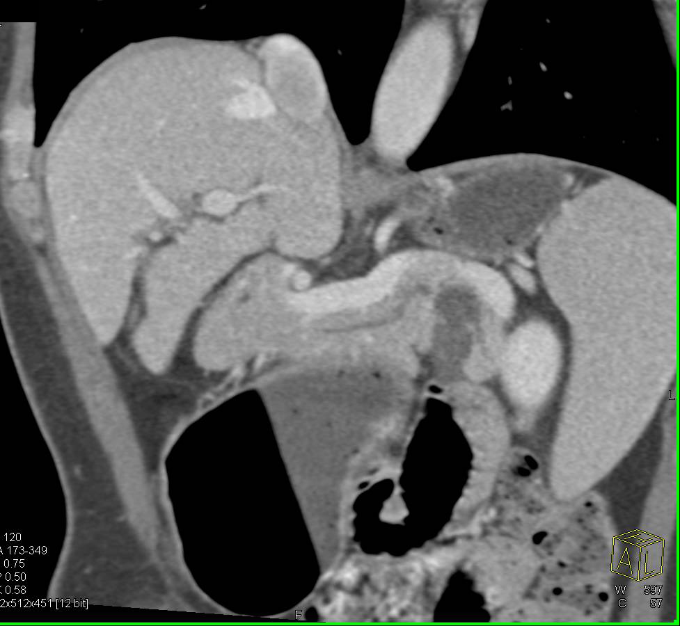 Intraductal Papillary Mucinous Neoplasm (IPMN) in Tail of the Pancreas - CTisus CT Scan