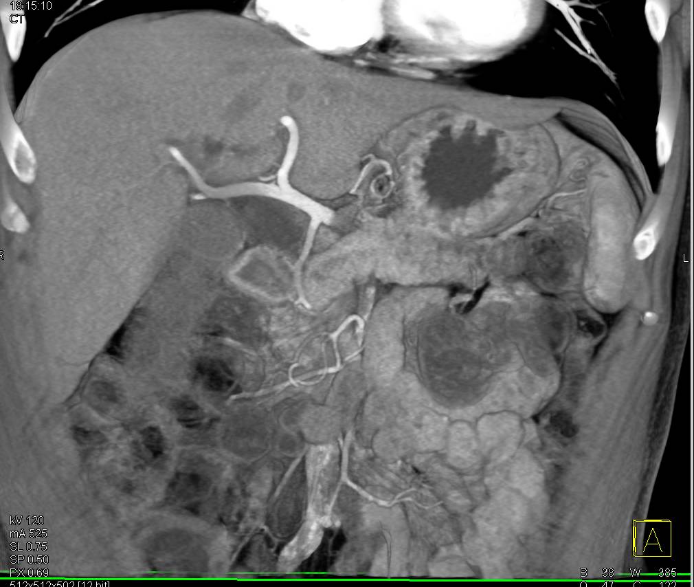 Pancreatic Adenocarcinoma - CTisus CT Scan