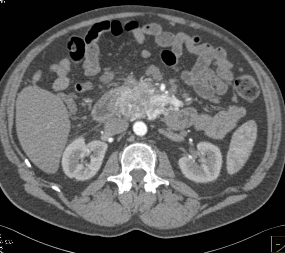 Neuroendocrine Tumor of the Pancreas (vascular) with Superior Mesenteric Vein (SMV) Encasement - CTisus CT Scan