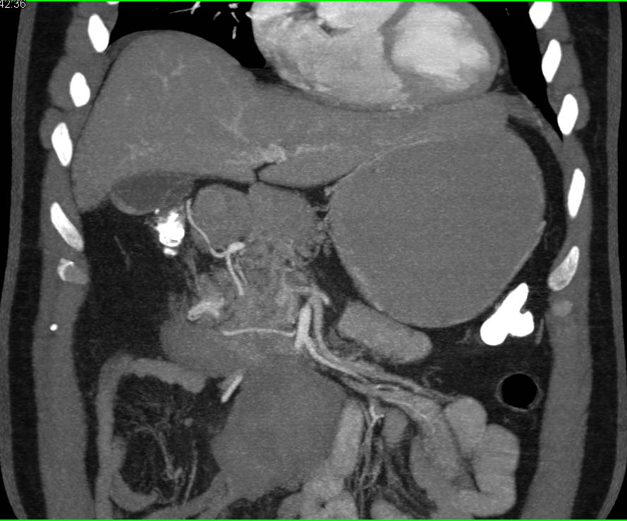 Pancreatitis with Mass Effect and Inflammation near Head of Pancreas with Pseudocyst - CTisus CT Scan