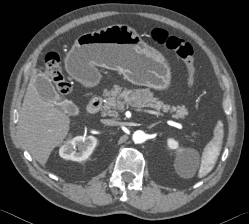 Adenocarcinoma of the Body of the Pancreas with Dilated Duct Distally - CTisus CT Scan