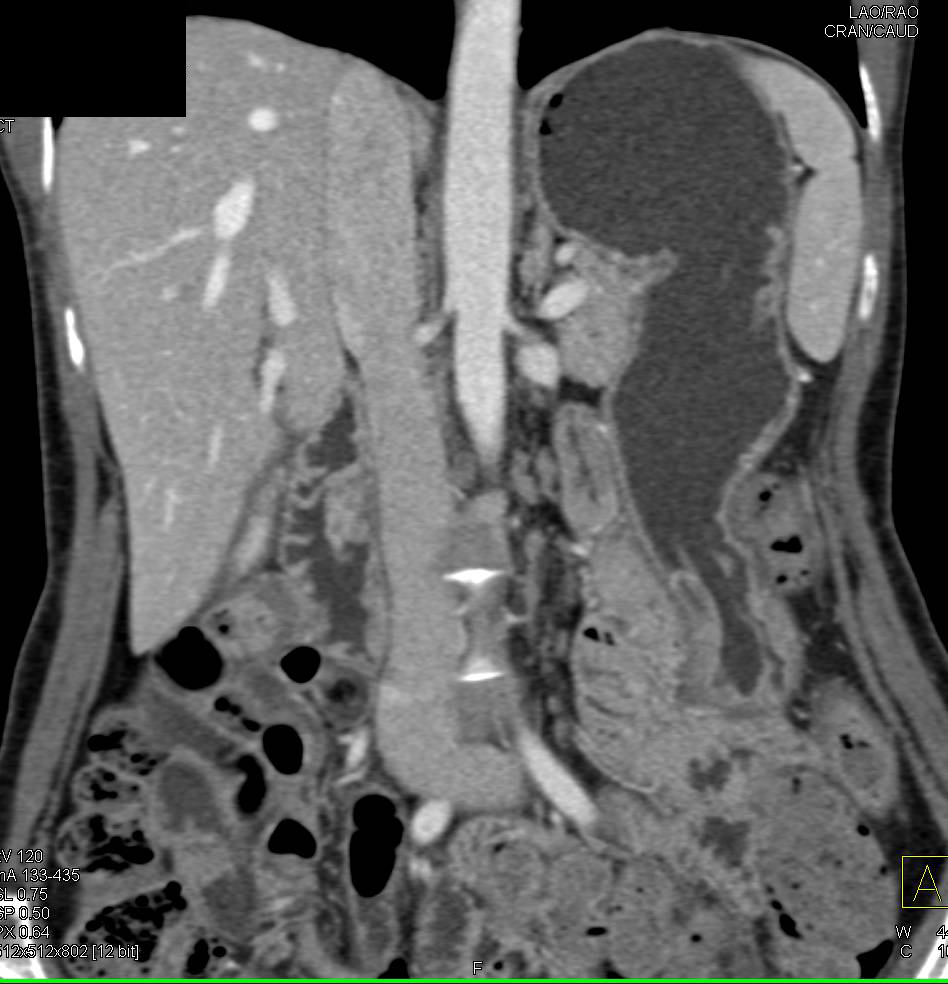 Ampullary Polypoid Mass - CTisus CT Scan