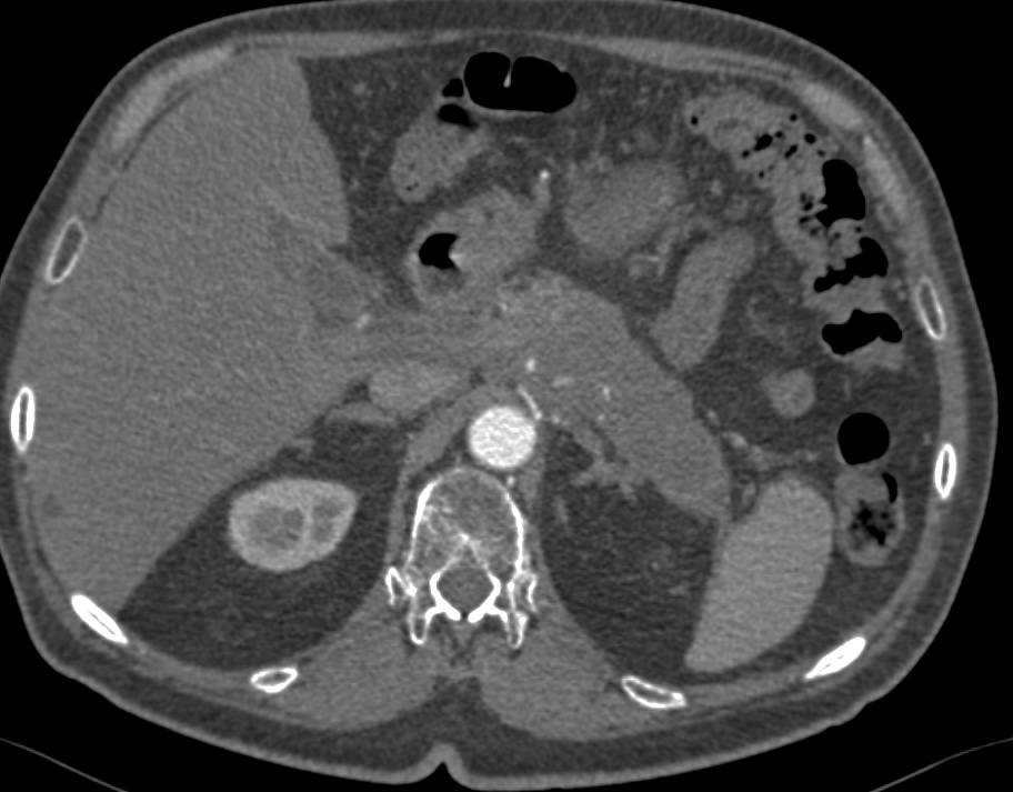 Autoimmune Pancreatitis Simulates Pancreatitis - CTisus CT Scan