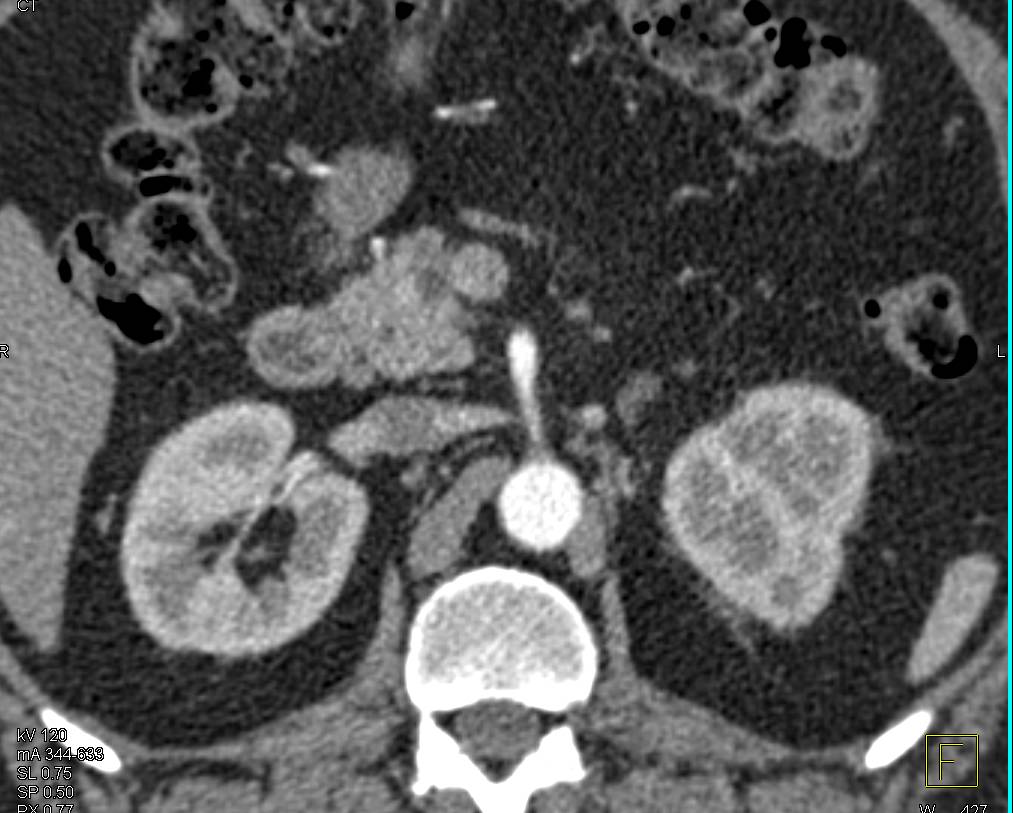 Neuroendocrine Tumor of the Pancreas (vascular) Obstructs the Pancreatic Duct - CTisus CT Scan