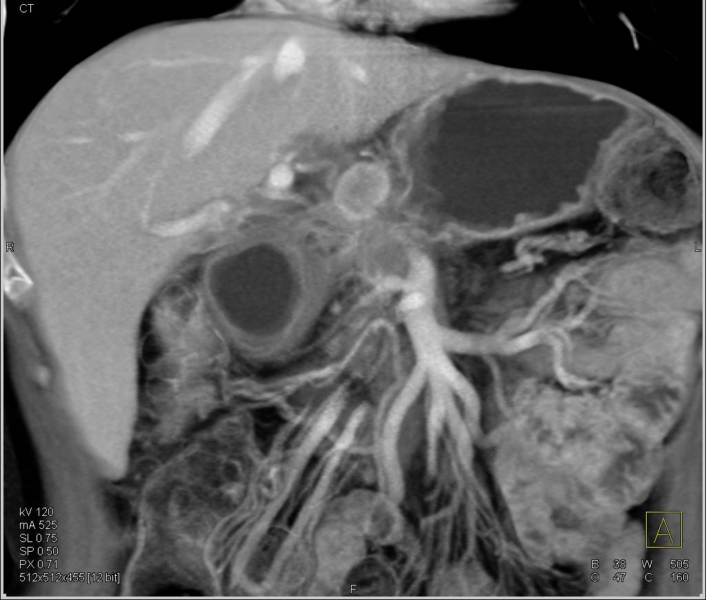 Pancreatic Cancer Invades the Stomach with Local Adenopathy as Well as Vessel Encasement all seen in 3D - CTisus CT Scan