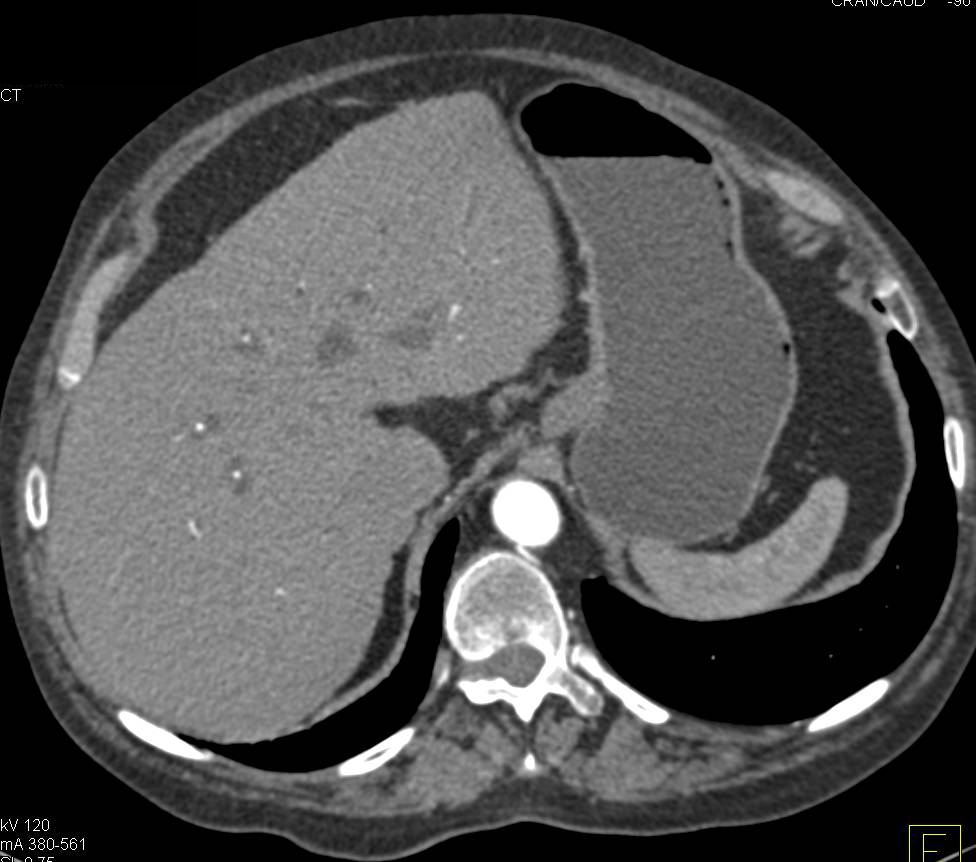 Ampullary Cancer with Double Duct Sign - CTisus CT Scan