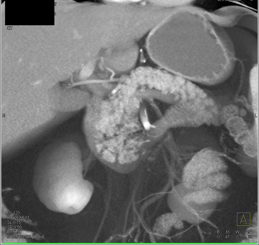 Mild Pancreatitis - CTisus CT Scan