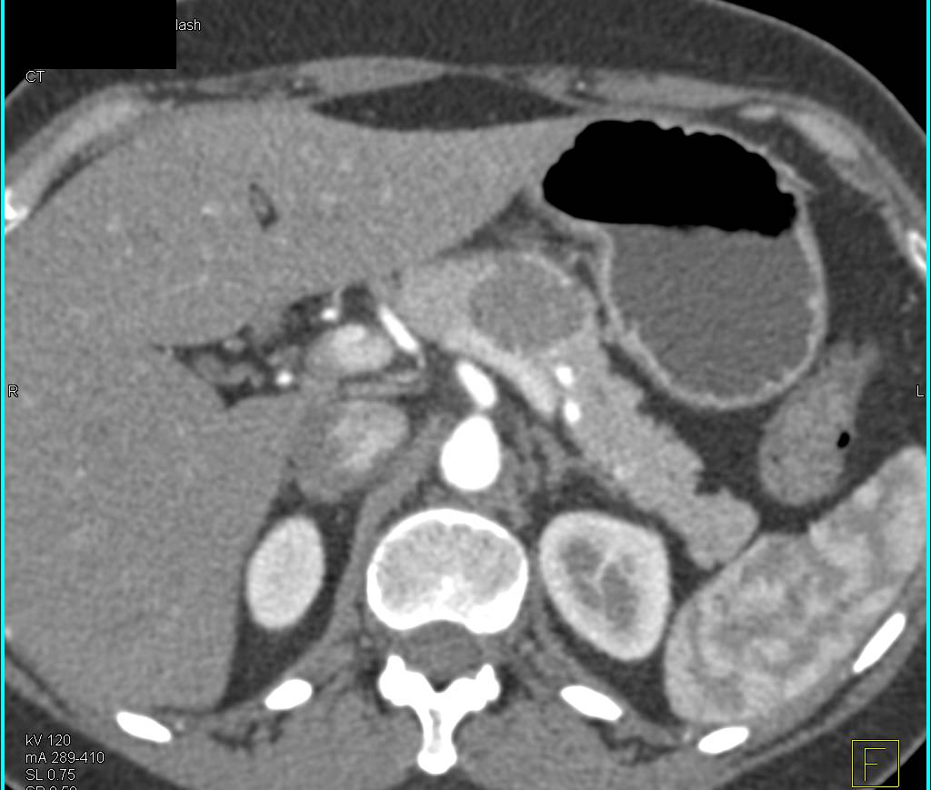 Serous Cystadenoma - CTisus CT Scan