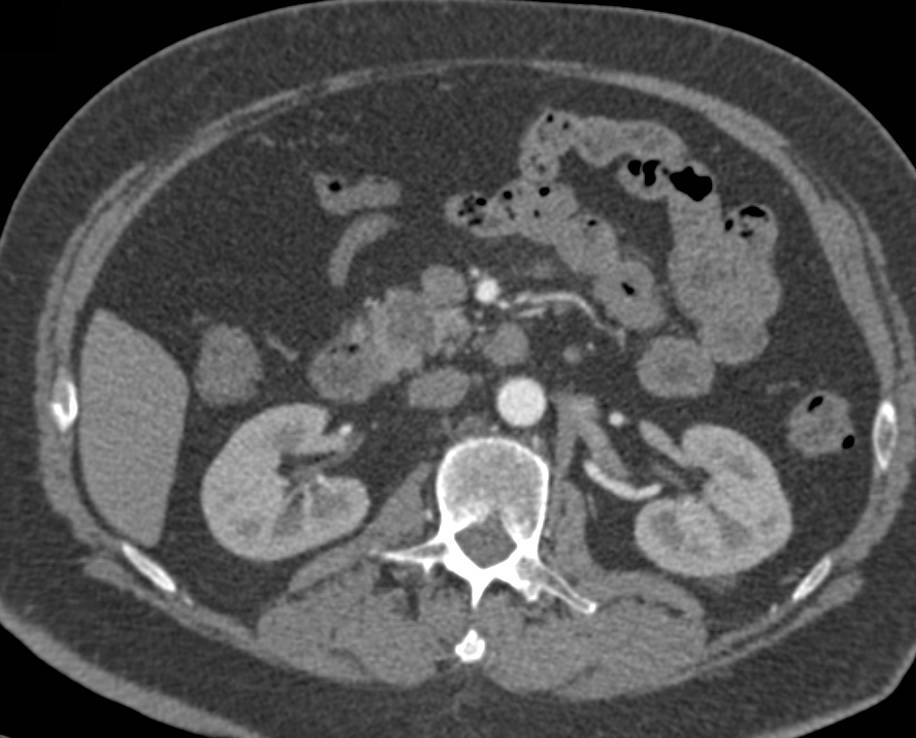 Unusual Serous Cystadenoma in the Head of the Pancreas - CTisus CT Scan