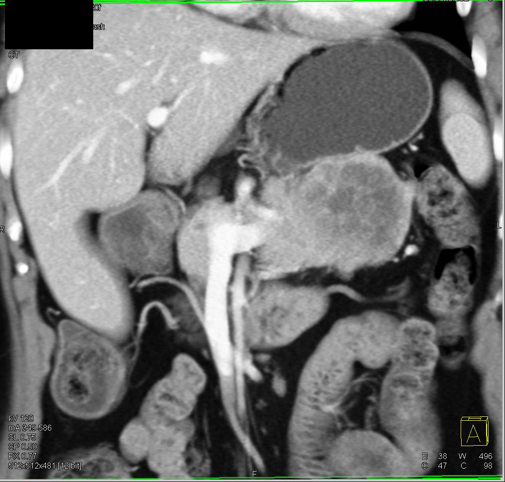 Mucinous Cystadenocarcinoma of the Tail of the Pancreas - CTisus CT Scan