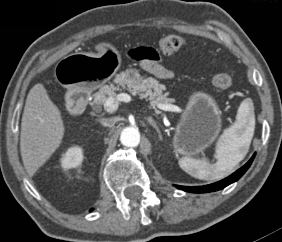 Hypovascular Neuroendocrine Tumor - CTisus CT Scan