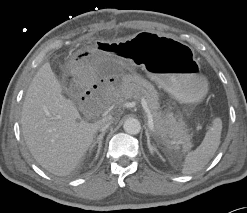 Acute Pancreatitis with Inflammation of the Duodenum - CTisus CT Scan