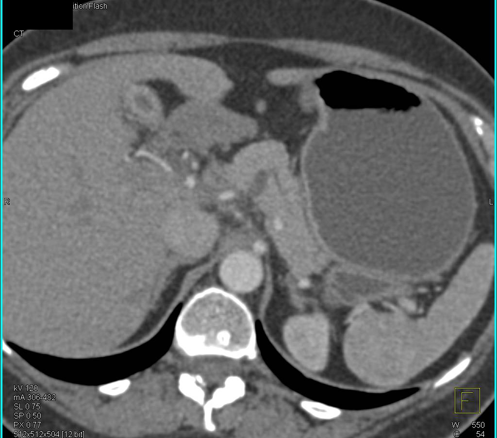 Intraductal Papillary Mucinous Neoplasm (IPMN) Body of Pancreas - CTisus CT Scan