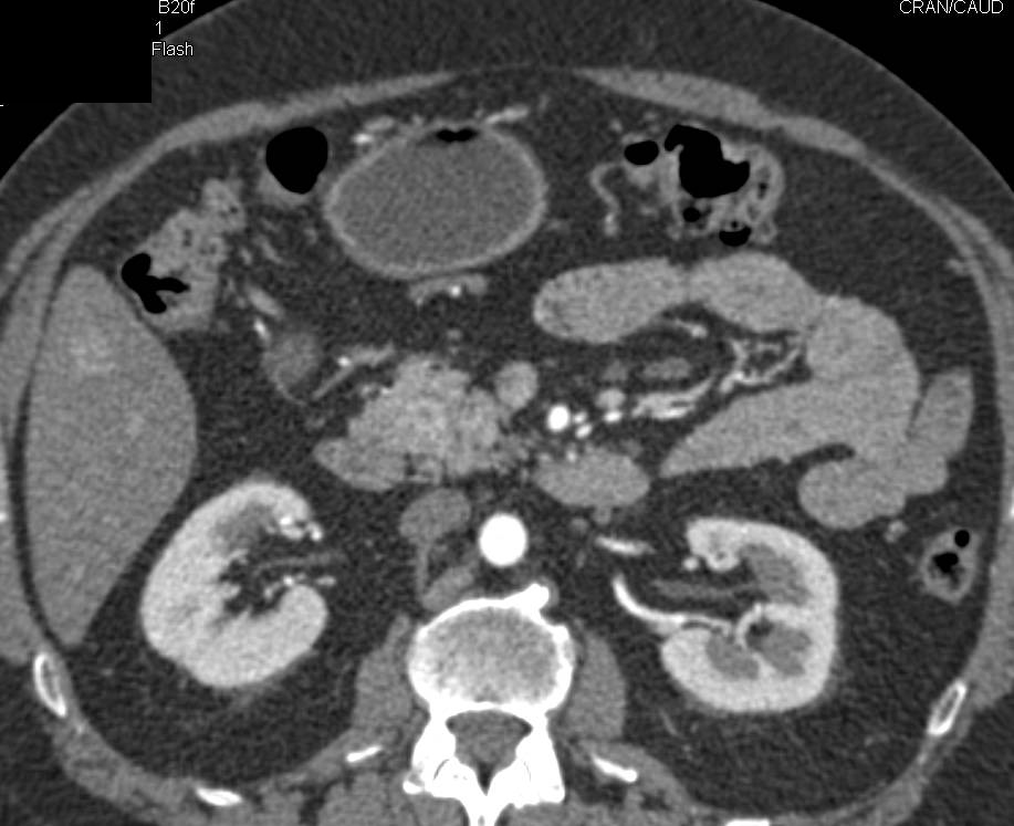 Gastrinoma with Enhancing 1 cm Head of Pancreas Mass and Enhancing Node Near C-Loop - CTisus CT Scan