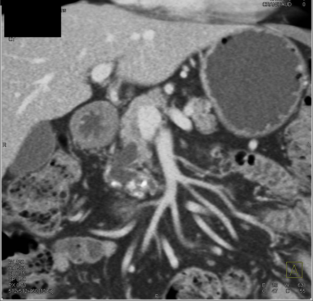 Pseudocyst from Prior Pancreatitis - CTisus CT Scan