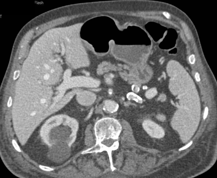 Subtle Neuroendocrine Tumor in the Head of the Pancreas - CTisus CT Scan