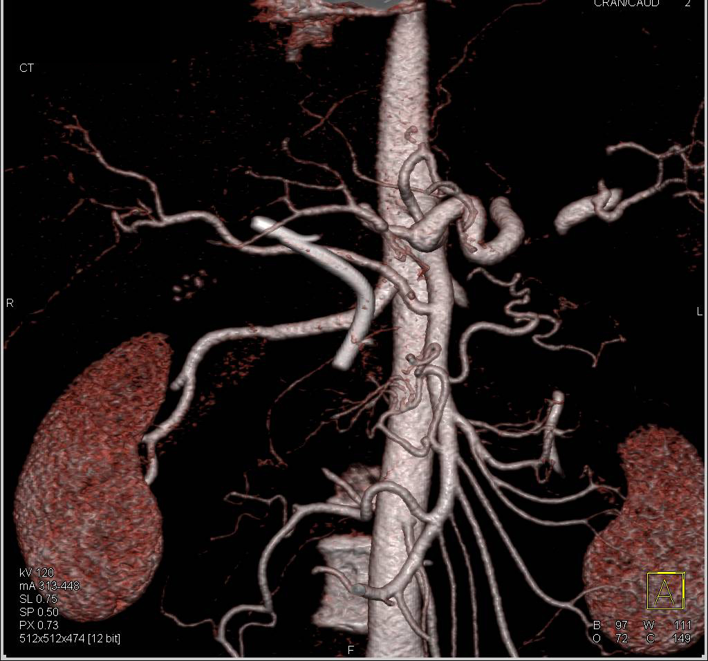 Pancreatic Cancer with Venous Involvement of Portal Vein and Superior Mesenteric Vein (SMV) - CTisus CT Scan