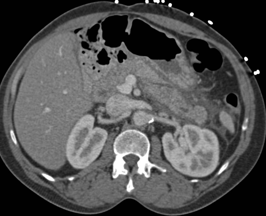 Acute Panceatitis - CTisus CT Scan