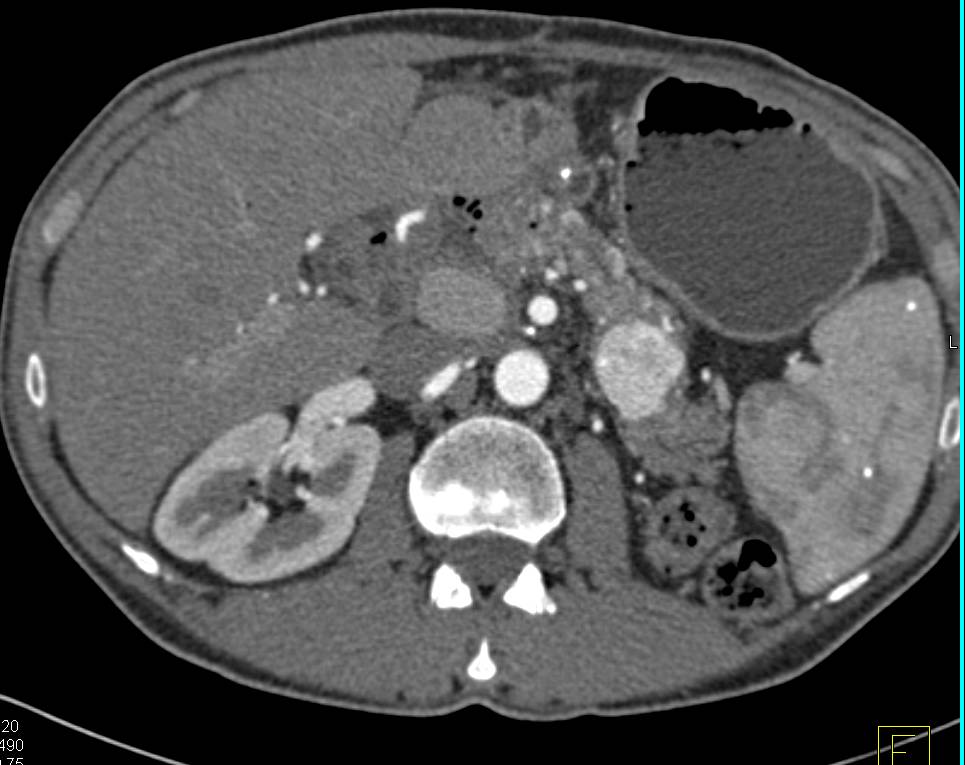 Renal Cell Carcinoma with Metastases to the Pancreas (Vascular Metastases) - CTisus CT Scan