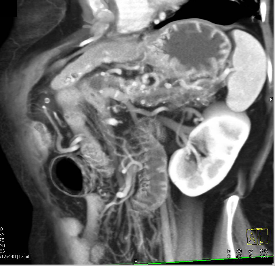 Central Intraductal Papillary Mucinous Neoplasm (IPMN) with Dilated Duct Throughout the Gland. Dysplastic Changes Seen at Pathology - CTisus CT Scan