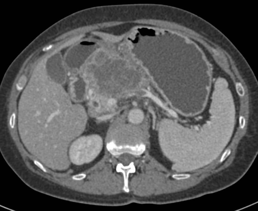 Necrotic Adenocarcinoma of the Pancreas Encasing the Celiac Artery and Occlusion of the Portal Vein/SMV Junction - CTisus CT Scan