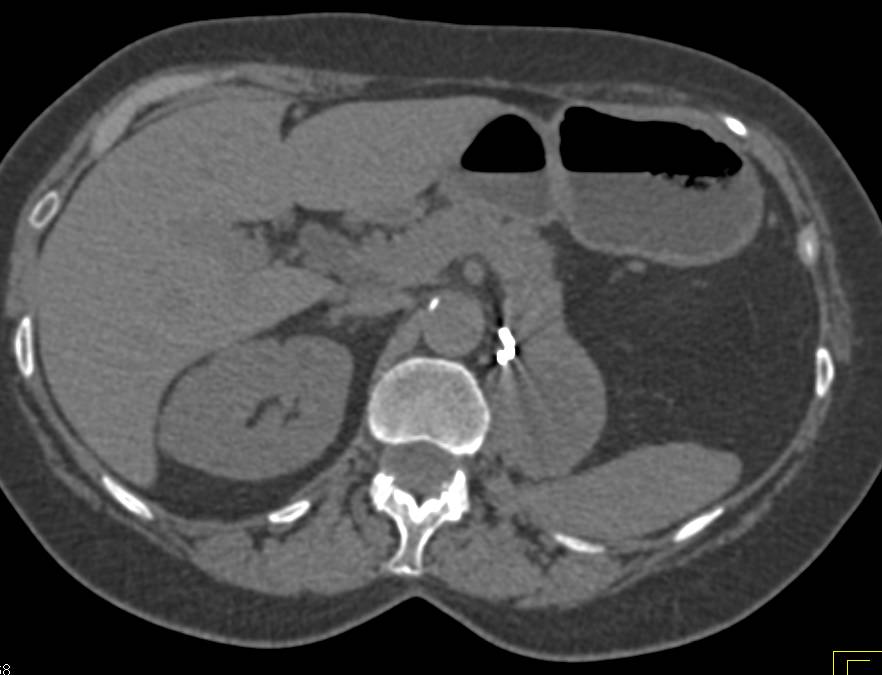 Renal Cell Carcinoma Metastatic to the Tail of the Pancreas in a Patient s/p Left Nephrectomy - CTisus CT Scan