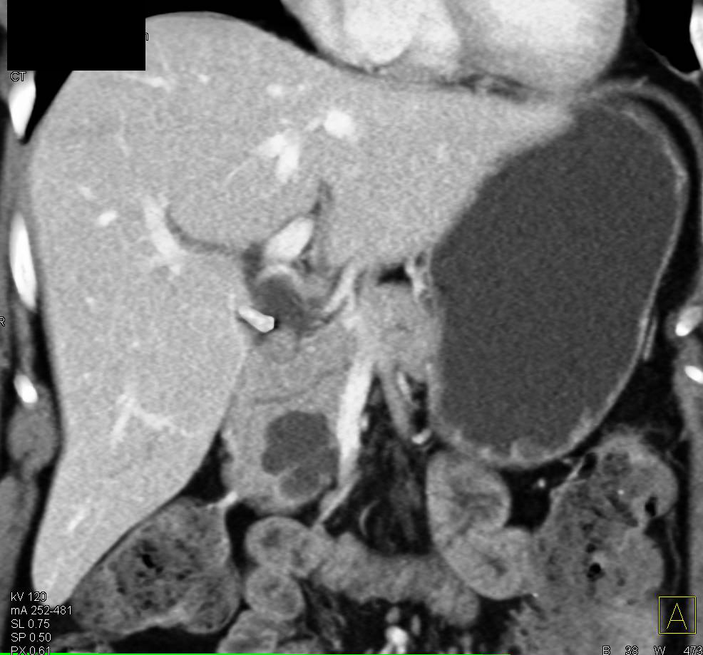 2.6 cm Intraductal Papillary Mucinous Neoplasm (IPMN) with Septations - CTisus CT Scan