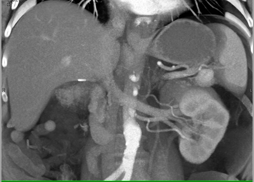 Recurrent Renal Cell Carcinoma Metastatic to the Pancreatic Gland - CTisus CT Scan