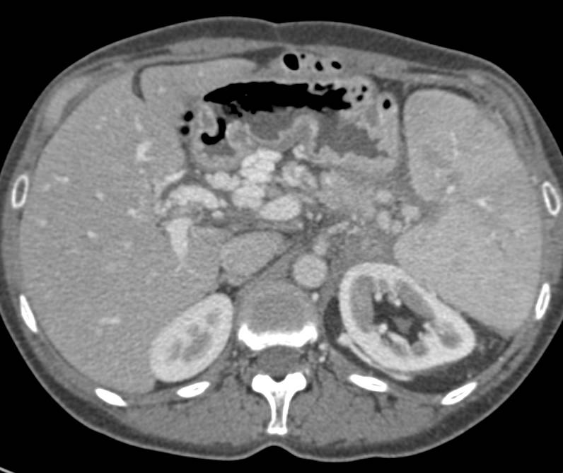 Pancreatic Cancer Encases the PV/SMV Confluence with Extensive Collaterals - CTisus CT Scan