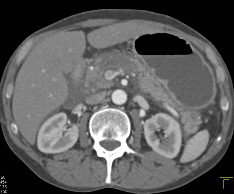 Acute Pancreatitis Simulates a Pancreatic Tumor with Focal Decreased Attenuation in the Body. Note Vascular Variation with Single Trunk for Superior Mesenteric Artery (SMA) and Celiac Artery. - CTisus CT Scan