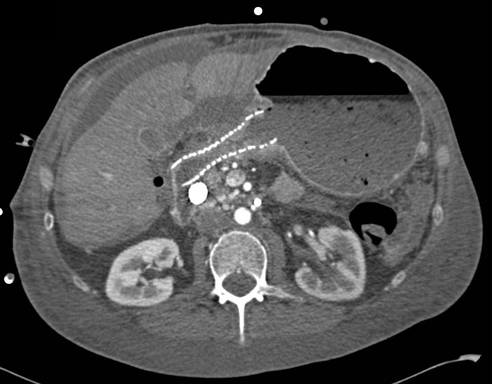 Invasive Pancreatic Cancer with Stent in the Duodenum and Carcinomatosis - CTisus CT Scan