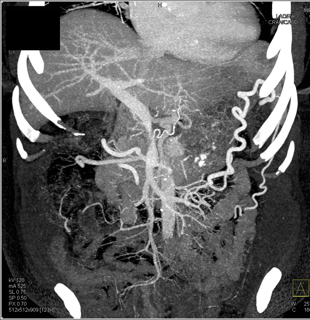 Pancreatic Cancer Encases the PV/SMV Confluence with Extensive Collaterals - CTisus CT Scan