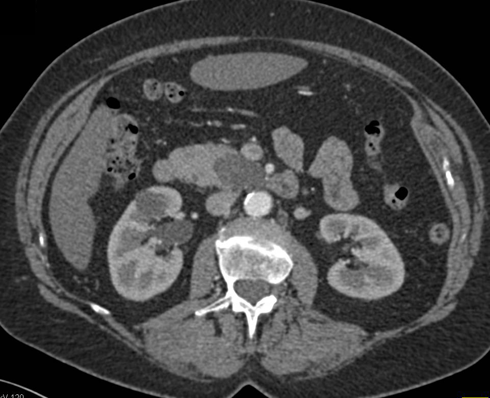 Intraductal Papillary Mucinous Neoplasm (IPMN) in the Uncinate Process - CTisus CT Scan