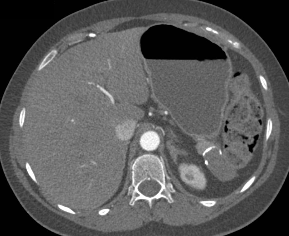 Pseudocyst at Tail of Pancreas - CTisus CT Scan