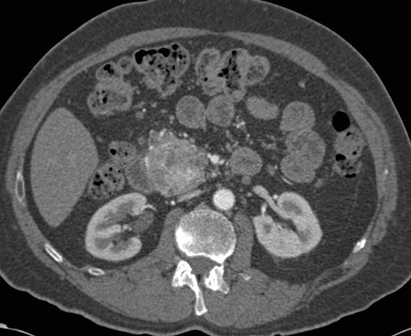 Neuroendocrine Tumor in the Head of the Pancreas - CTisus CT Scan