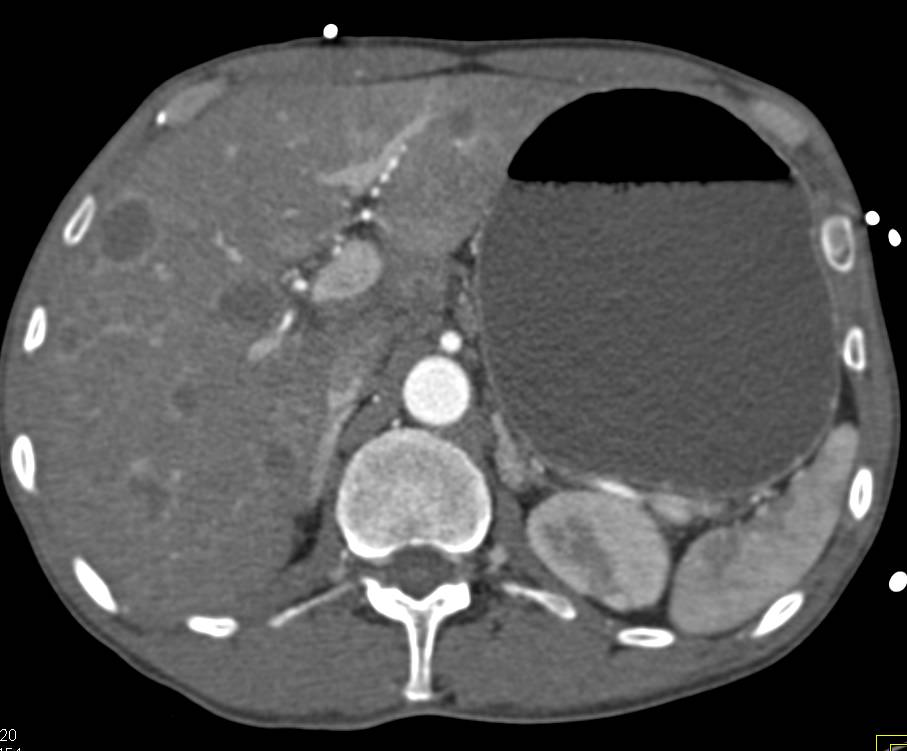 Pancreatic Cancer Invading the Duodenum in a Patient with Extensive Tumor Spread - CTisus CT Scan