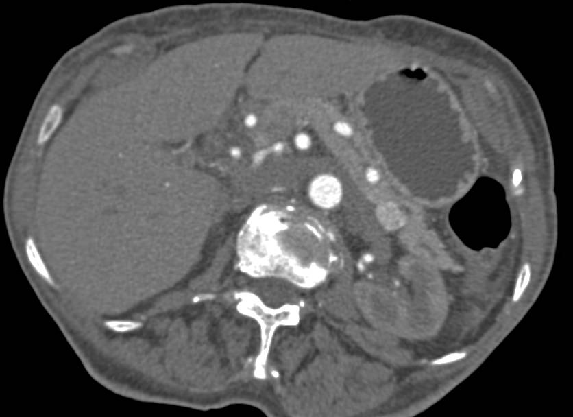 Incidental 1.2 cm Neuroendocrine Tumor of the Pancreas - CTisus CT Scan