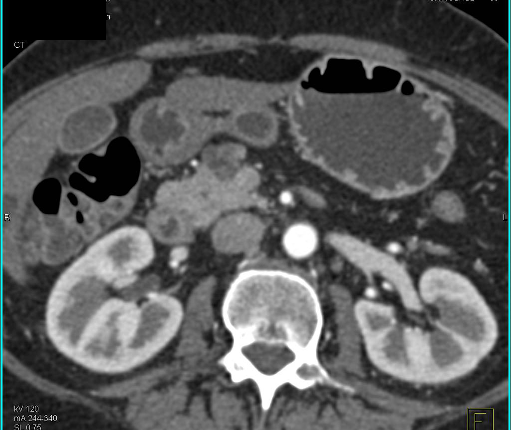 Intraductal Papillary Mucinous Neoplasm (IPMN) of the Pancreas with Septations in the Mass and Dilated Pancreatic Duct - CTisus CT Scan