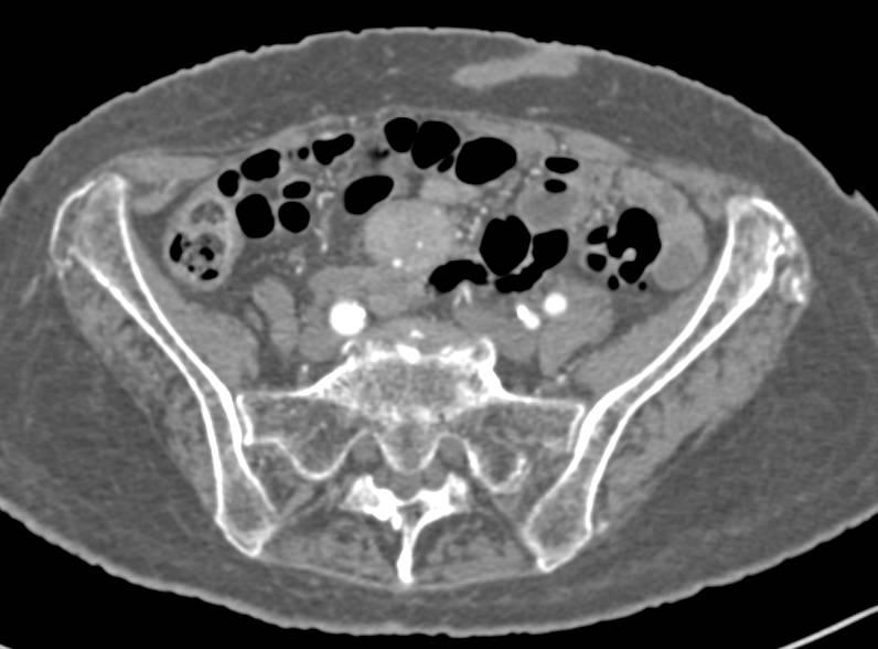 Classic Carcinoid Tumor in the Root of the Mesentery - CTisus CT Scan